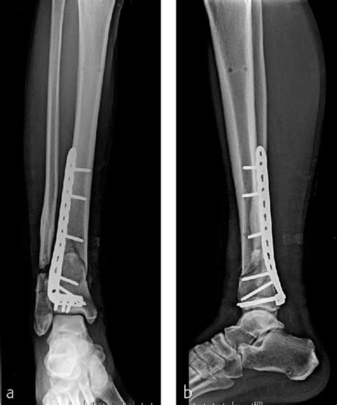 Tibia and fibula, distal: extraarticular multifragmentary distal tibial fracture—43-A3 in ...