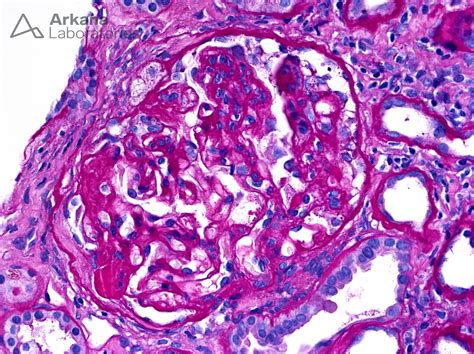 Focal Segmental Glomerulosclerosis (FSGS) | Teaching Points