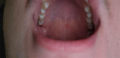 painful sore on roof of mouth. should I be concerned : r/medical_advice