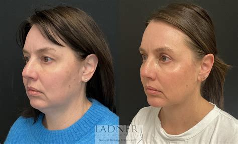 Minimally Invasive Neck Tightening Before and After Pictures Case 228 | Denver, CO | Ladner ...