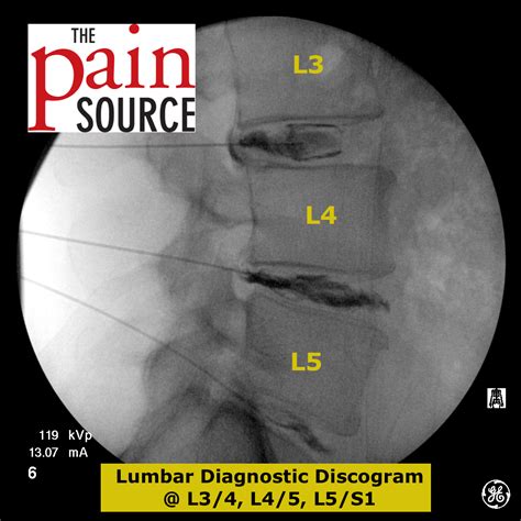 Image result for Lumbar Discogram