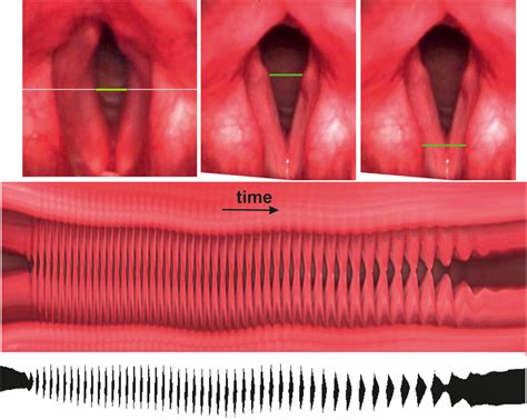 High-Speed Image Analysis Comparing Loading of Vocal Folds During Coughing and Phonation: A Case ...
