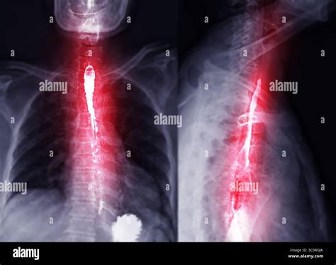 Fluoroscopic footage of a barium swallow test showing real-time esophageal function, used to ...