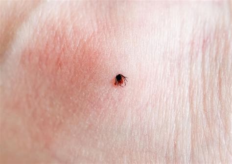 Image result for Embedded Deer Tick