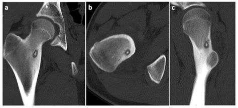 Current Approaches to Osteoid Osteoma and Minimally Invasive Surgery—A ...