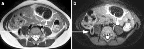 Image result for Normal Appendix MRI