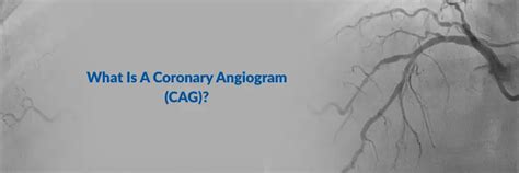 Angiografía coronaria (CAG): procedimiento, riesgos y resultados