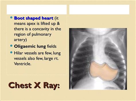 Tetralogy of fallot | PPT