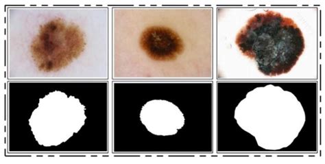 Skin Lesion Segmentation and Multiclass Classification Using Deep ...