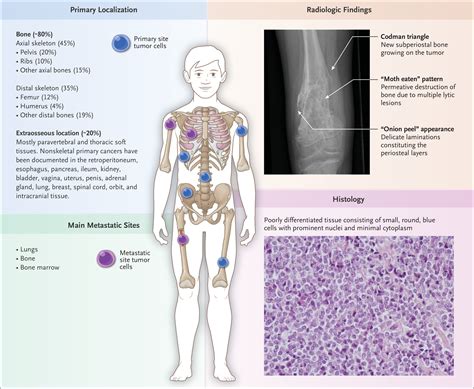 Ewing Sarcoma Survival Rate