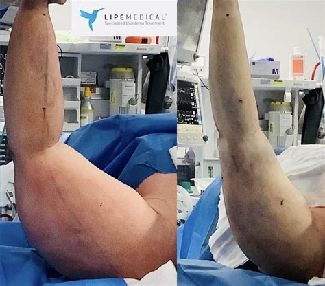 Lipedema in the Upper Arms | How to Treat Lipedema in the Upper Arms - Lipedema and Me