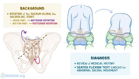 Sacral Torsion: What Is It, Causes, Treatment, and More | Osmosis