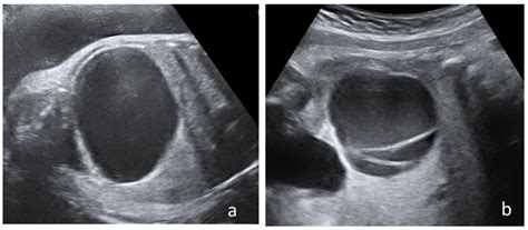 Ovarian Cyst While Pregnant