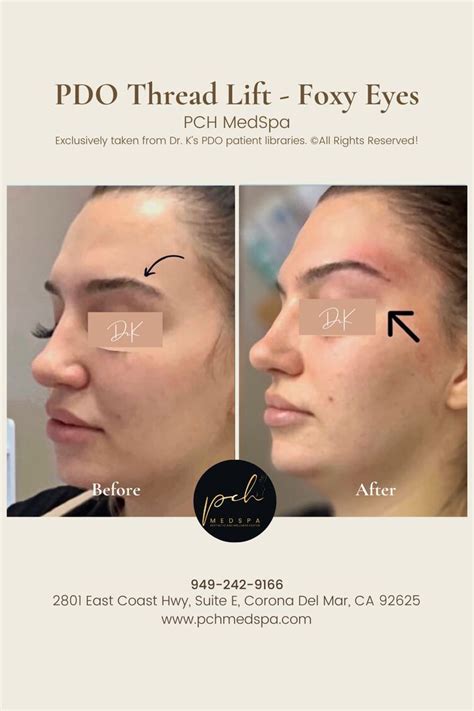 Image result for Cheek Threads