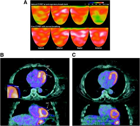 Frequent Diagnostic Errors in Cardiac PET/CT Due to Misregistration of CT Attenuation and ...