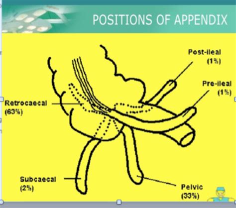 Image result for Appendix Variants