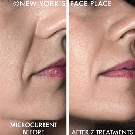 Before & After | Advanced Microcurrent Science for Anti-Aging