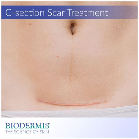 Cesarean Section Incision Types