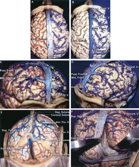 Cortical Veins Entering the Superior Sagittal Sinus | Neuroanatomy ...