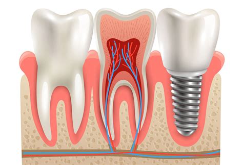 Image result for Different Types of Teeth Implants