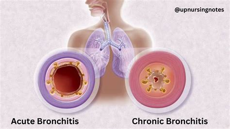 Bronchitis - definition, causes, symptoms, pathophysiology, medical treatment