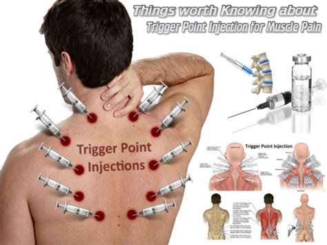 Trigger Point Injections 的图像结果