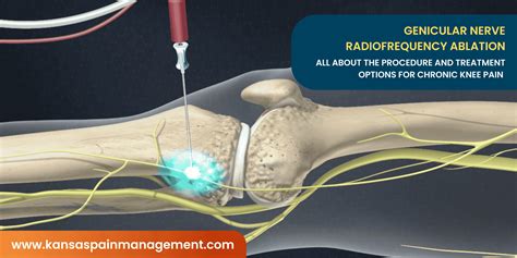 Genicular Radiofrequency Ablation in Kansas City