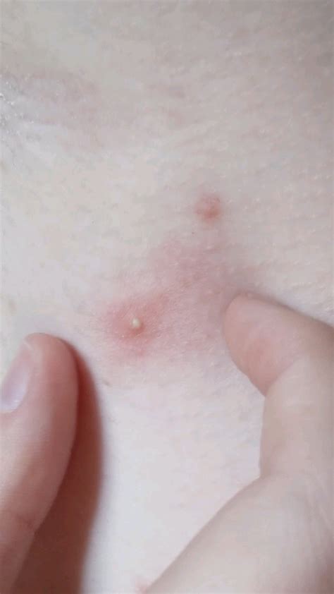 Exploding Armpit Zits 的图像结果