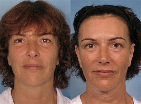 Sculptra® Before and After Pictures Case 126 | Naples and Ft. Myers, FL | Kent V. Hasen, MD ...
