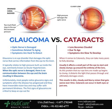 Glaucoma symptoms causes types treatment – Artofit