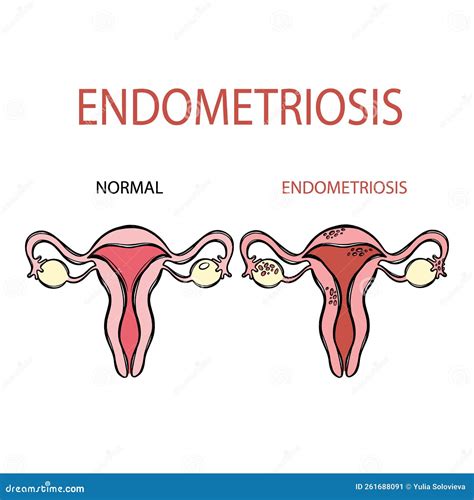 ENDOMETRIOSIS NORMAL FEMALE Reproductive System Education Stock Illustration - Illustration of ...
