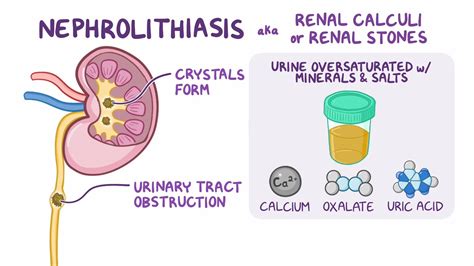 Nephrolithiasis Amboss