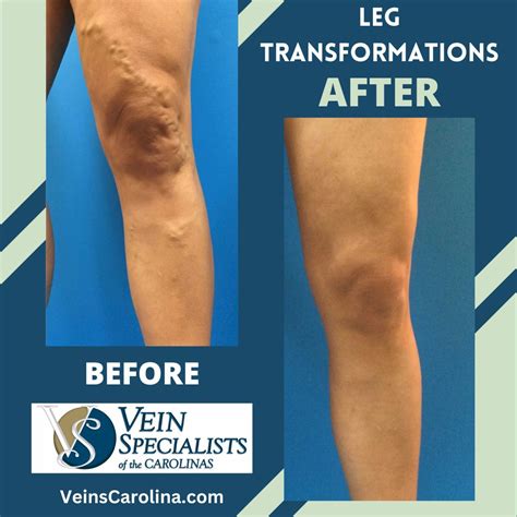 LEG TRANSFORMATIONS - Before and After Varicose Veins Treatment - Vein Specialists of the Carolinas