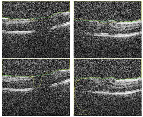 An Automated CAD System for Accurate Grading of Uveitis Using Optical ...