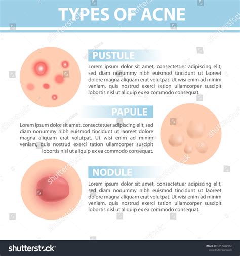 Pustule Vs Papule