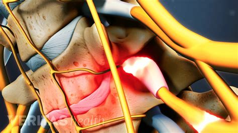 Image result for C8 Selective Nerve Root Block