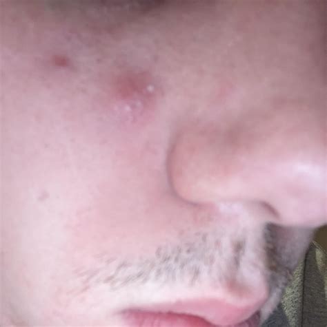 Image result for Big Cysts Exploding