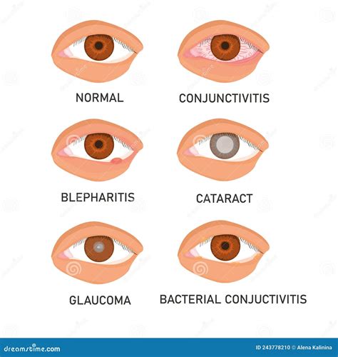 Image result for Types of Vision Problems