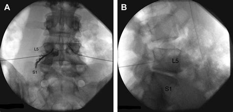 Lumbosacral Transitional Segments - Physical Medicine and ...