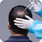 Hair transplant: What are the procedures and side effects?