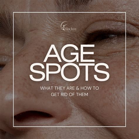 Age Spots Guide: Causes, Prevention & Treatments | St. Pete, FL
