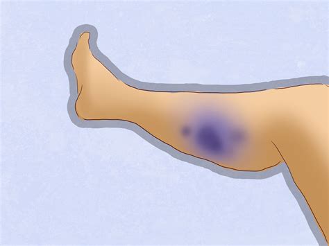 3 Ways to Diagnose a Torn Calf Muscle - wikiHow | Torn calf muscle ...