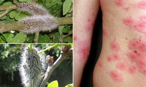 Image result for Moth Rash