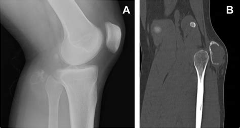 Osteosarcoma Jaw X Ray