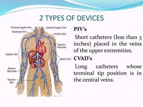 Central venous access catheter – Artofit