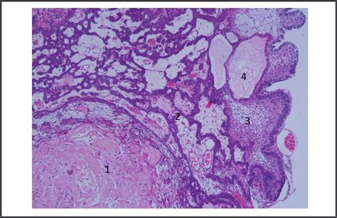 ¿Qué sabemos de craneofaringioma? Una revisión actualizada de los ...