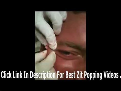 Image result for Big Zits Exploding at Home