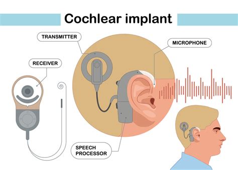 Image result for How Cochlear Implants Sound