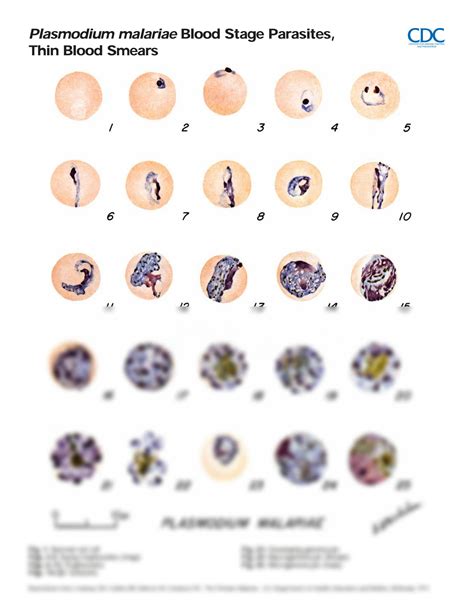 SOLUTION: comparison of malaria blood stage in thick and thin blood ...