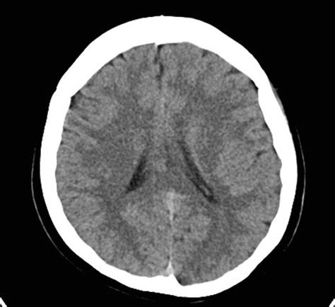 Image result for Normal Brain CT Scan Head